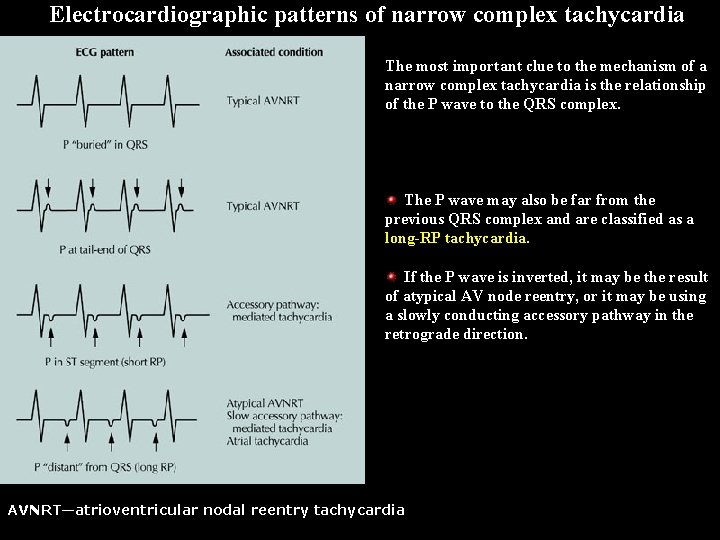 Electrocardiographic patterns of narrow complex tachycardia The most important clue to the mechanism of