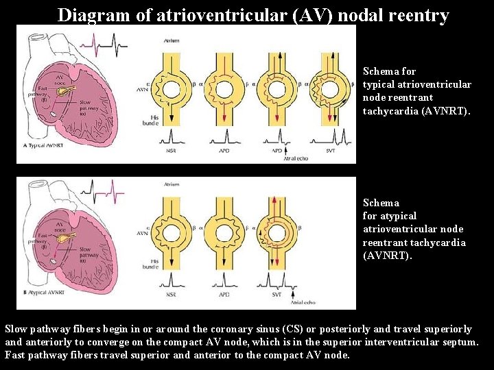 Diagram of atrioventricular (AV) nodal reentry AV N reent ry Schema for typical atrioventricular