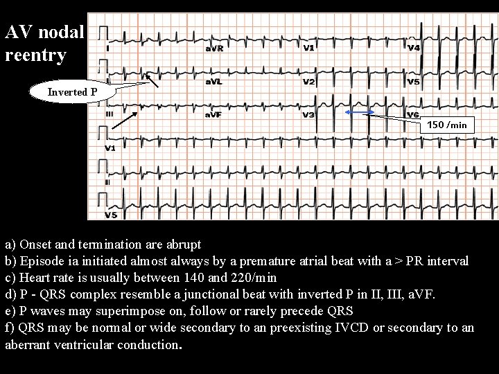 AV nodal reentry Inverted P 150 /min A V N R T a) Onset