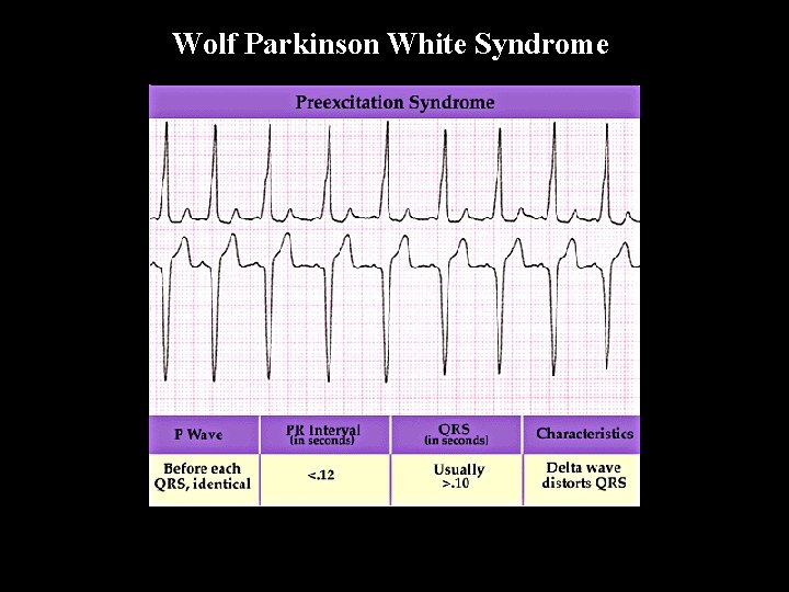 Wolf Parkinson White Syndrome W P W 