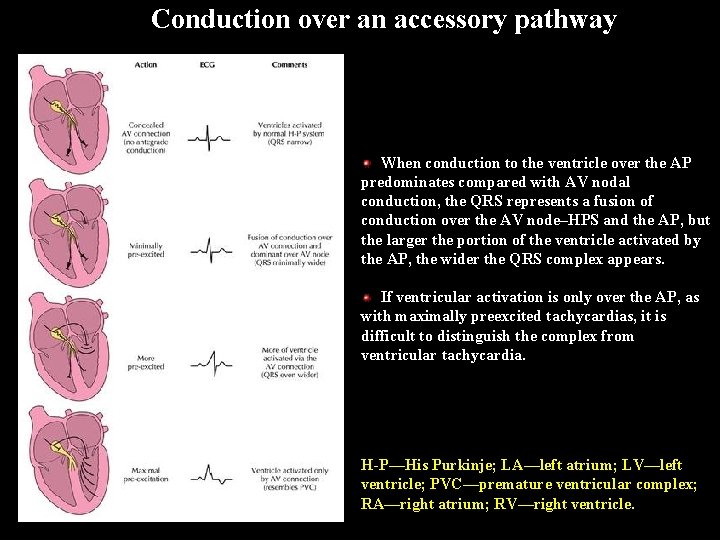 Conduction over an accessory pathway When conduction to the ventricle over the AP predominates