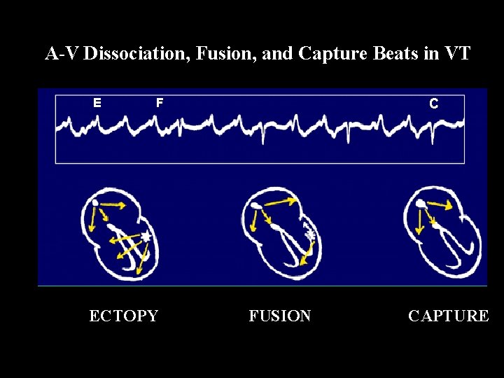 A-V Dissociation, Fusion, and Capture Beats in VT E F ECTOPY C FUSION CAPTURE