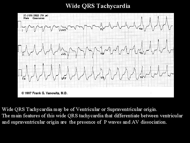 Wide QRS Tachycardia may be of Ventricular or Supraventricular origin. The main features of