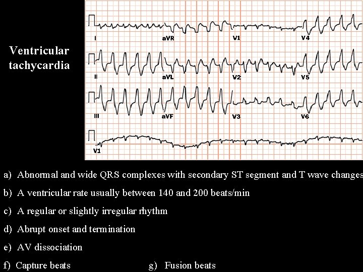 Ventricular tachycardia a) Abnormal and wide QRS complexes with secondary ST segment and T