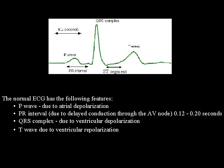 normal ECG ST segment The normal ECG has the following features: • P wave