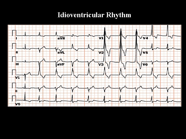 Idioventricular Rhythm 