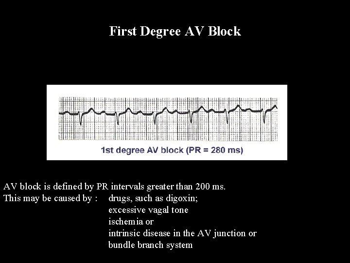 First Degree AV Block AV block is defined by PR intervals greater than 200