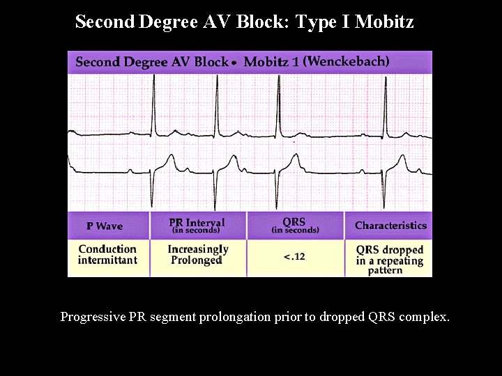 Second Degree AV Block: Type I Mobitz Progressive PR segment prolongation prior to dropped