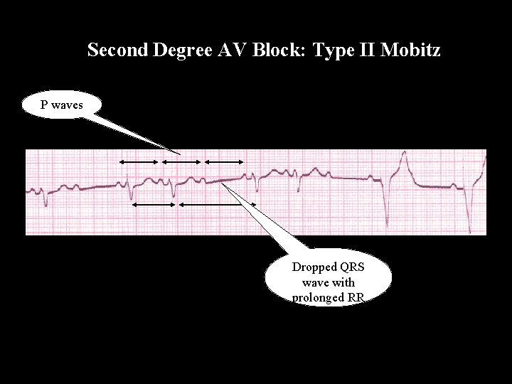 Second Degree AV Block: Type II Mobitz P waves Dropped QRS wave with prolonged