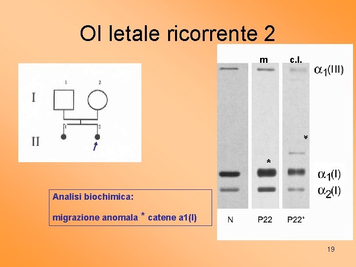 OI letale ricorrente 2 m c. l. * * Analisi biochimica: migrazione anomala *