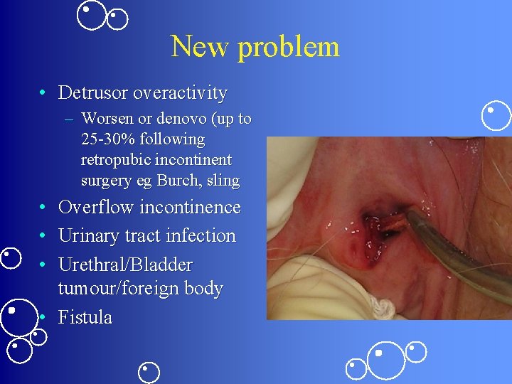 New problem • Detrusor overactivity – Worsen or denovo (up to 25 -30% following