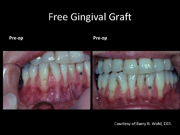 Gum graft cost philippines