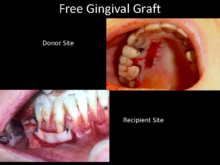 Free Gingival Graft Donor Site Recipient Site 