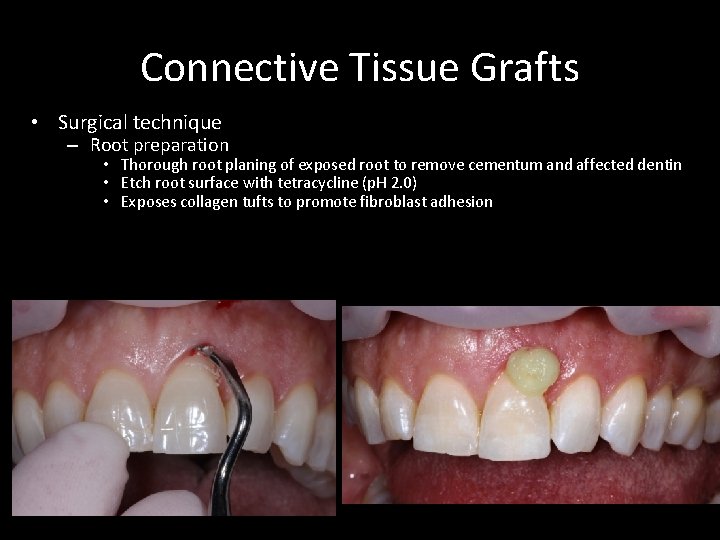 Connective Tissue Grafts • Surgical technique – Root preparation • Thorough root planing of