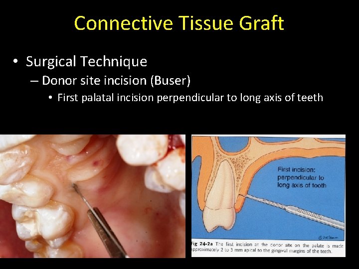 Connective Tissue Graft • Surgical Technique – Donor site incision (Buser) • First palatal