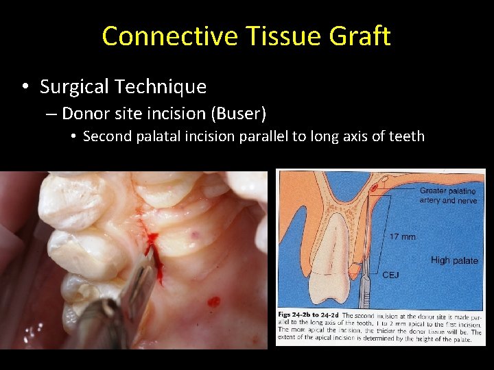 Connective Tissue Graft • Surgical Technique – Donor site incision (Buser) • Second palatal