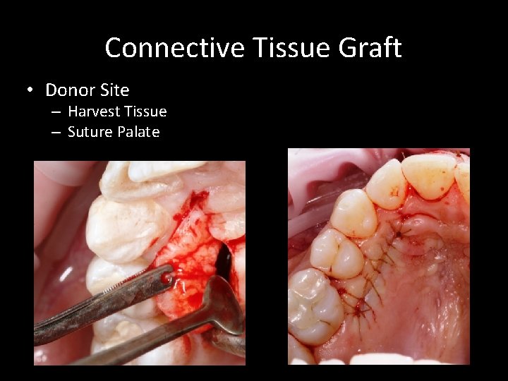 Connective Tissue Graft • Donor Site – Harvest Tissue – Suture Palate 