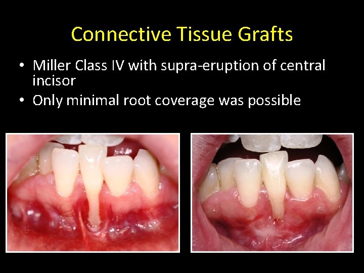 Connective Tissue Grafts • Miller Class IV with supra-eruption of central incisor • Only
