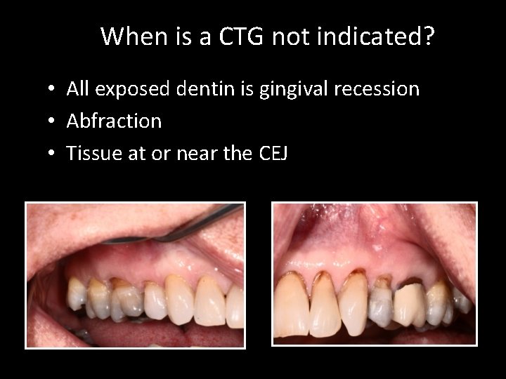 When is a CTG not indicated? • All exposed dentin is gingival recession •