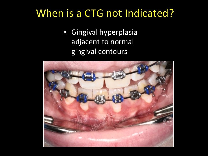 When is a CTG not Indicated? • Gingival hyperplasia adjacent to normal gingival contours
