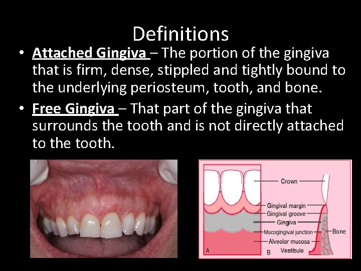 Definitions • Attached Gingiva – The portion of the gingiva that is firm, dense,