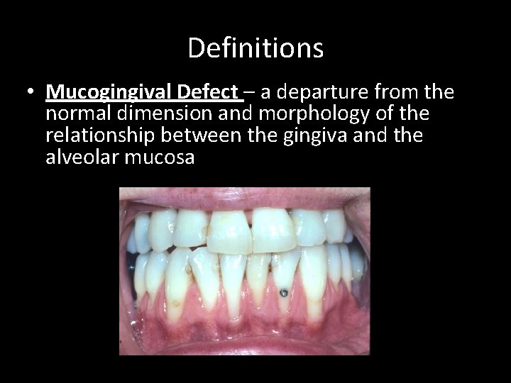 Definitions • Mucogingival Defect – a departure from the normal dimension and morphology of