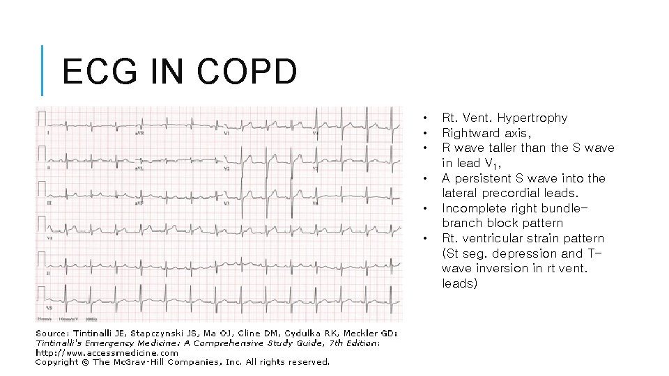 ECG IN COPD • • • Rt. Vent. Hypertrophy Rightward axis, R wave taller ECG IN COPD • • • Rt. Vent. Hypertrophy Rightward axis, R wave taller