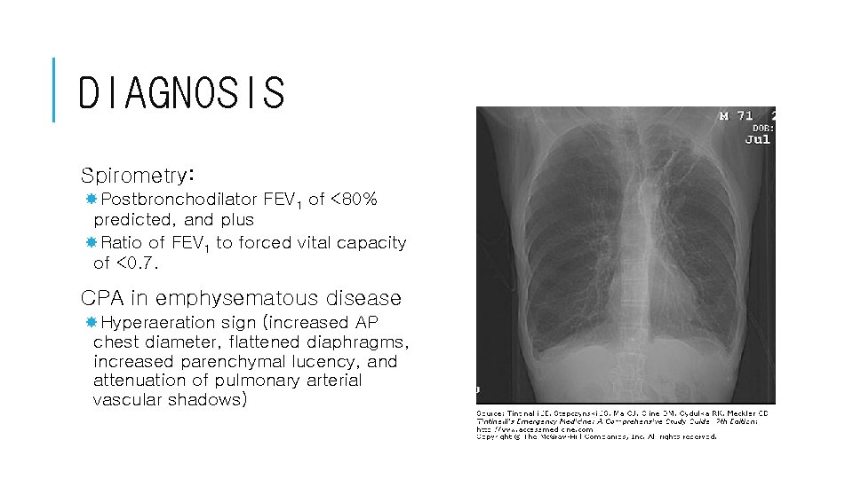 DIAGNOSIS Spirometry: Postbronchodilator FEV 1 of <80% predicted, and plus Ratio of FEV 1