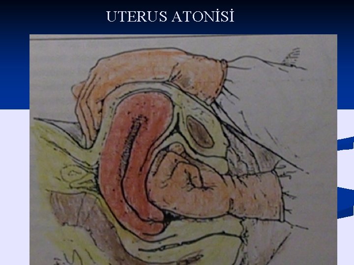 UTERUS ATONİSİ Sağlandı 