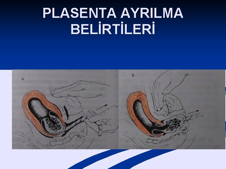 PLASENTA AYRILMA BELİRTİLERİ n Vajenden kan boşalır. n Uterus yukarı çekilir. n Kord aşağı