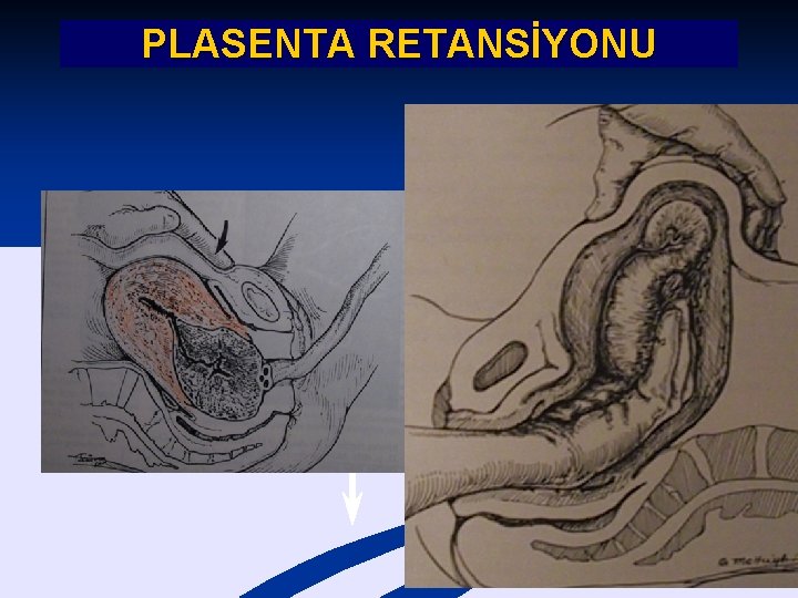 PLASENTA RETANSİYONU 