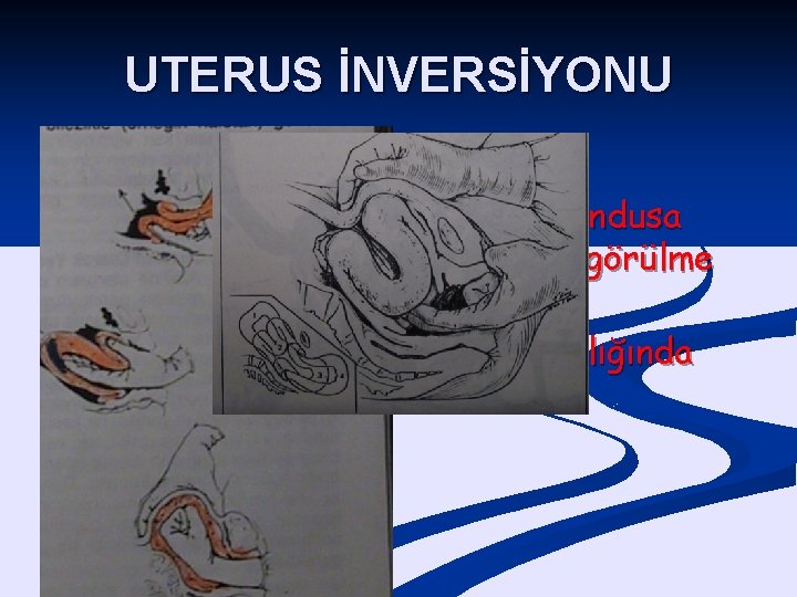 UTERUS İNVERSİYONU 2000 Doğumda bir görülür !? n Plasentanın elle çıkartılması, fundusa aşırı baskı