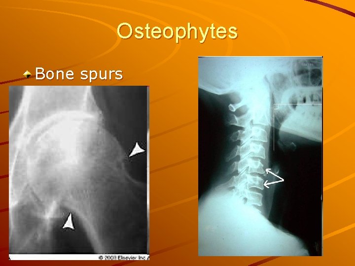 Osteophytes Bone spurs 