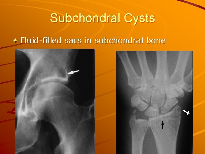 Subchondral Cysts Fluid-filled sacs in subchondral bone 