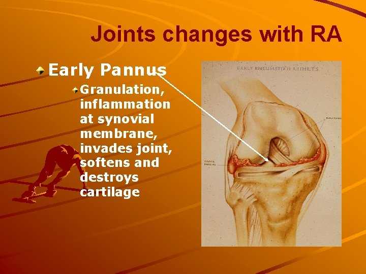 Joints changes with RA Early Pannus Granulation, inflammation at synovial membrane, invades joint, softens
