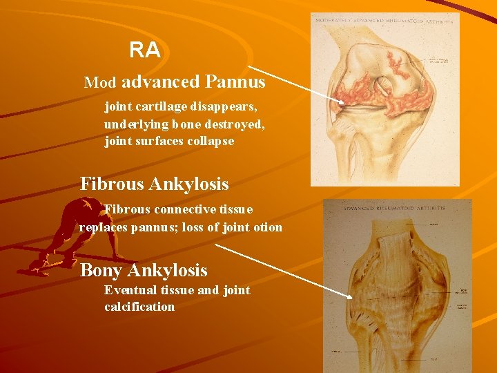 RA Mod advanced Pannus joint cartilage disappears, underlying bone destroyed, joint surfaces collapse Fibrous