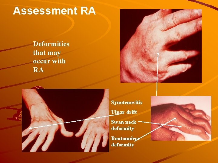 Assessment RA Deformities that may occur with RA Synotenovitis Ulnar drift Swan neck deformity