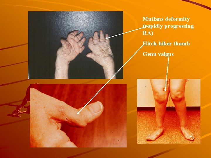 Mutlans deformity (rapidly progressing RA) Hitch-hiker thumb Genu valgus 