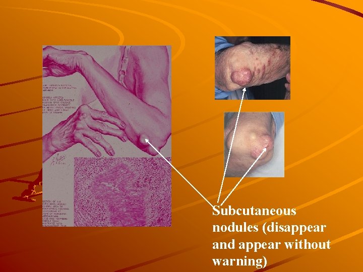 Subcutaneous nodules (disappear and appear without warning) 