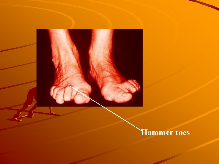 Hammer toes 