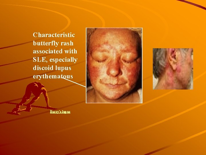 Characteristic butterfly rash associated with SLE, especially discoid lupus erythematous Barry’s lupus 