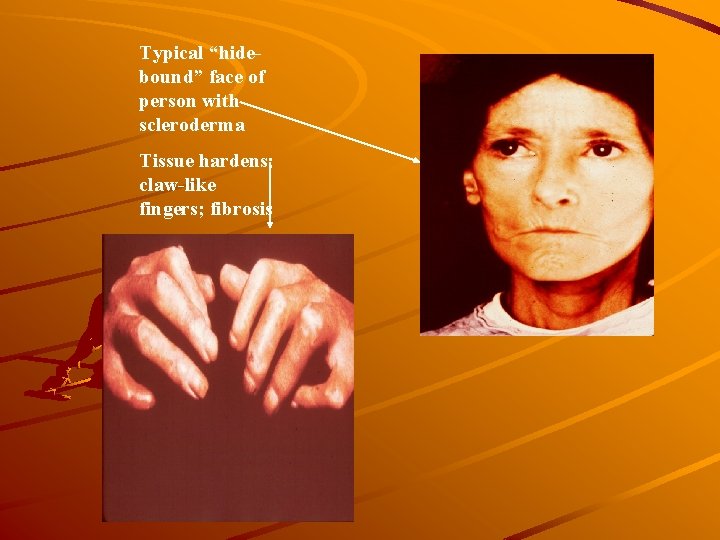 Typical “hidebound” face of person with scleroderma Tissue hardens; claw-like fingers; fibrosis 