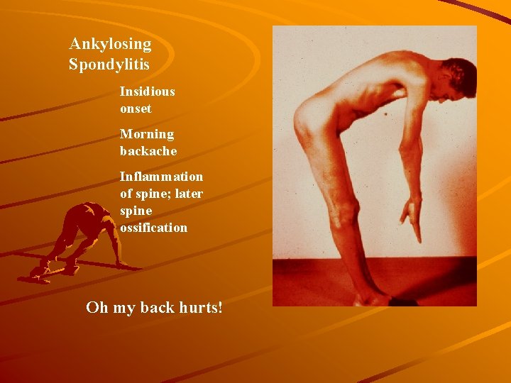 Ankylosing Spondylitis Insidious onset Morning backache Inflammation of spine; later spine ossification Oh my