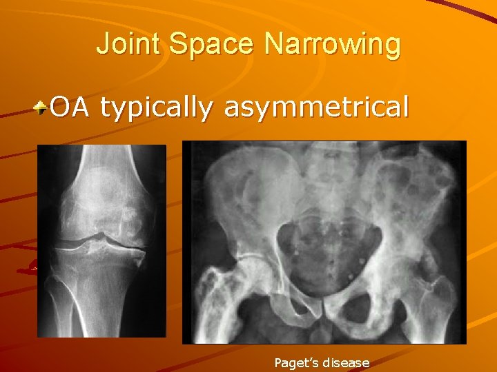 Joint Space Narrowing OA typically asymmetrical Paget’s disease 