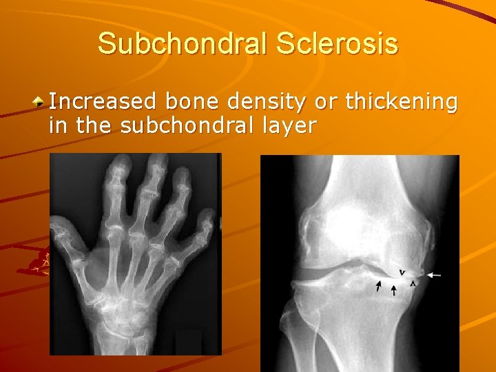 Subchondral Sclerosis Increased bone density or thickening in the subchondral layer 