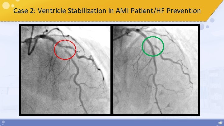 Case 2: Ventricle Stabilization in AMI Patient/HF Prevention 28 