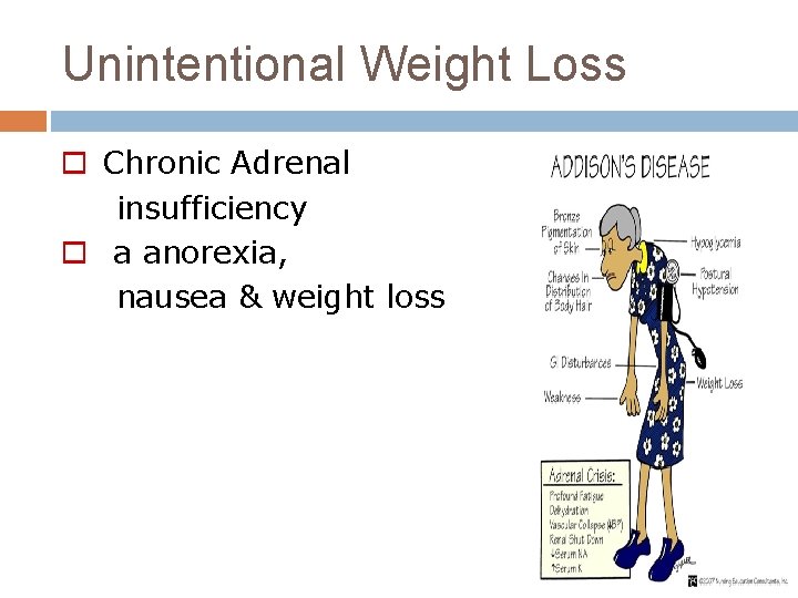 Unintentional Weight Loss o Chronic Adrenal insufficiency o a anorexia, nausea & weight loss
