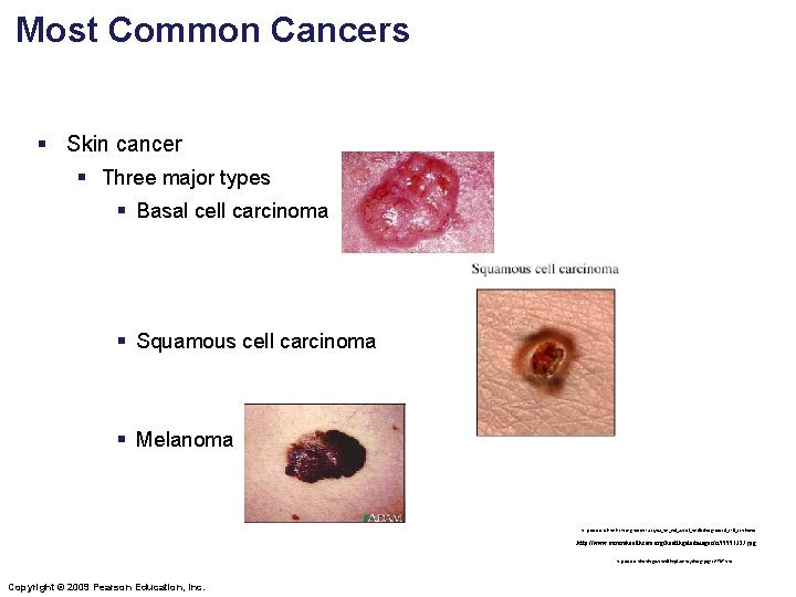 Most Common Cancers § Skin cancer § Three major types § Basal cell carcinoma