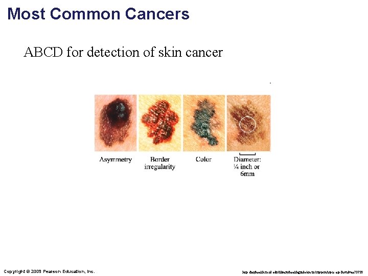 Most Common Cancers ABCD for detection of skin cancer Copyright © 2009 Pearson Education,
