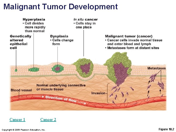 Malignant Tumor Development Cancer 1 Cancer 2 Copyright © 2009 Pearson Education, Inc. Figure